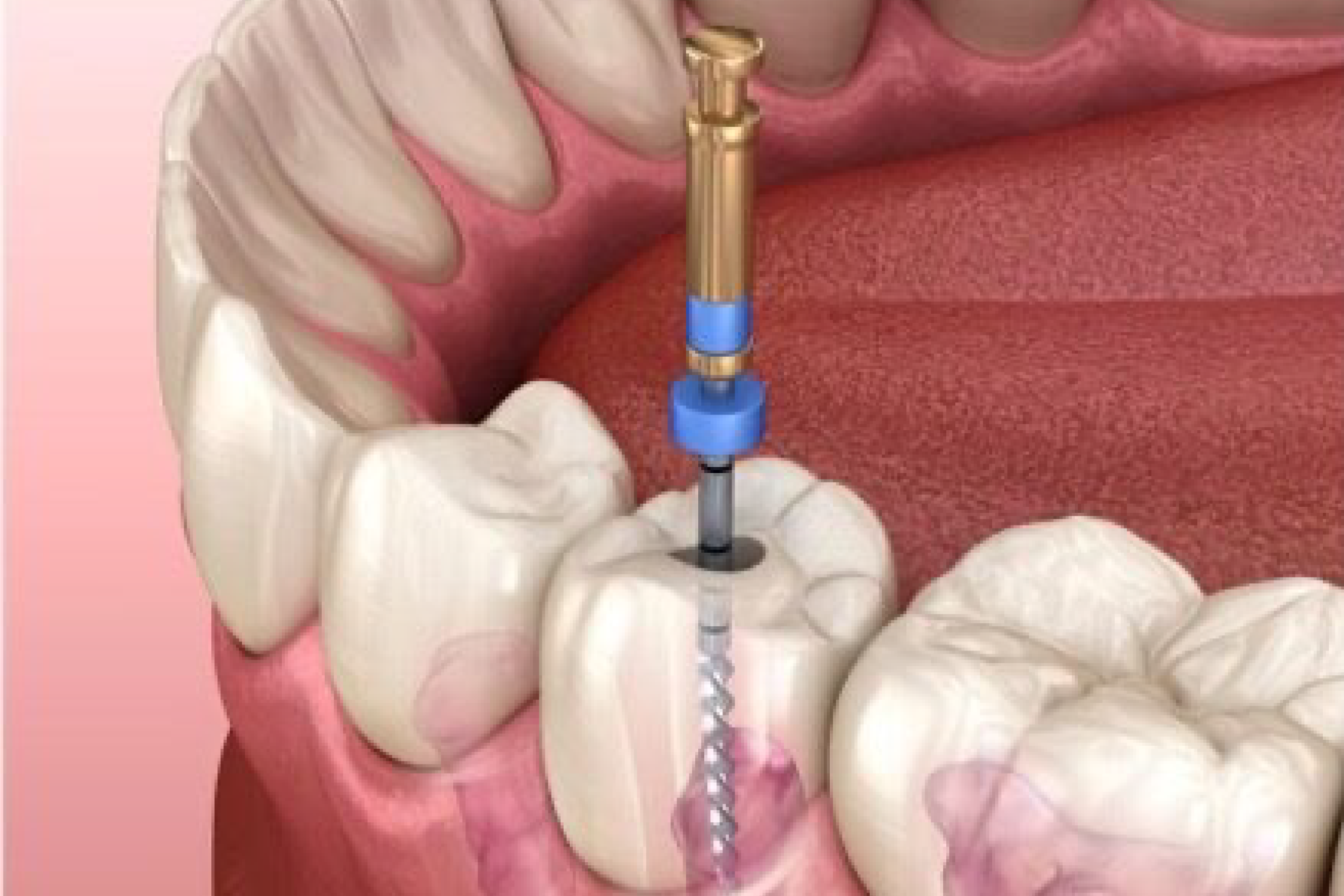 Endodoncia