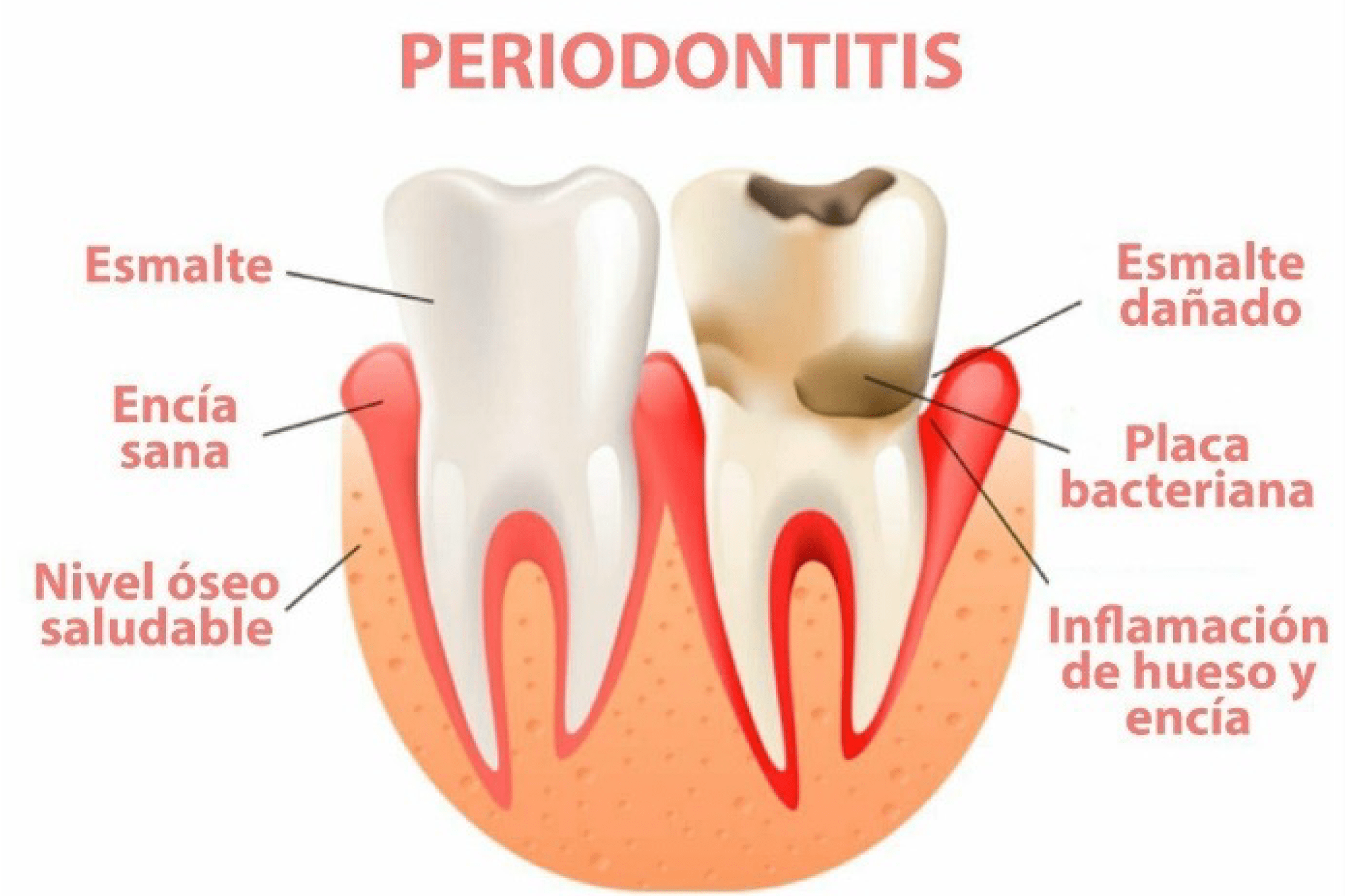 Periodoncia